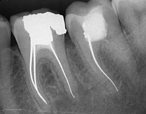 Endodoncja (kanałowe)
